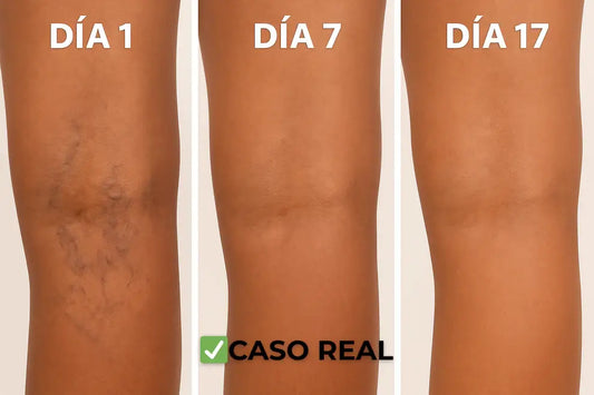 Varicura™ – Siente el alivio desde el primer uso